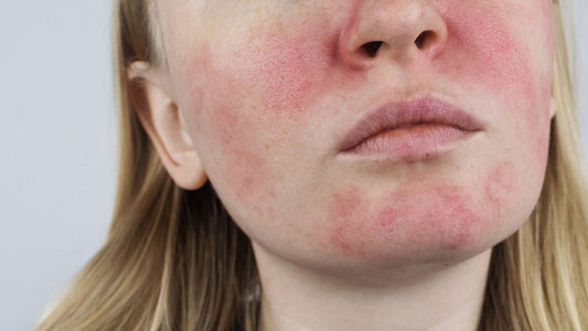 que es la rosacea