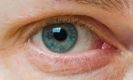 5 Trucos para eliminar las bolsas de los ojos y las ojeras