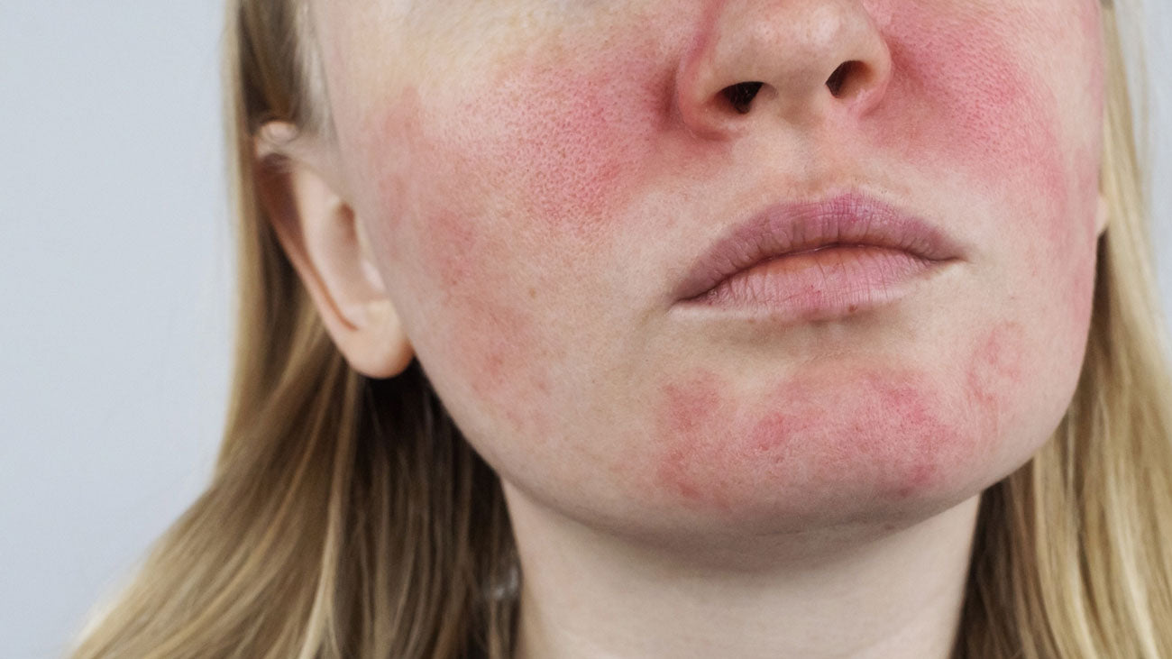 Qu Es La Ros cea 6 Trucos Para Calmar El Enrojecimiento Facial qu-es-la-ros-cea-6-trucos-para-calmar-el-enrojecimiento-facial