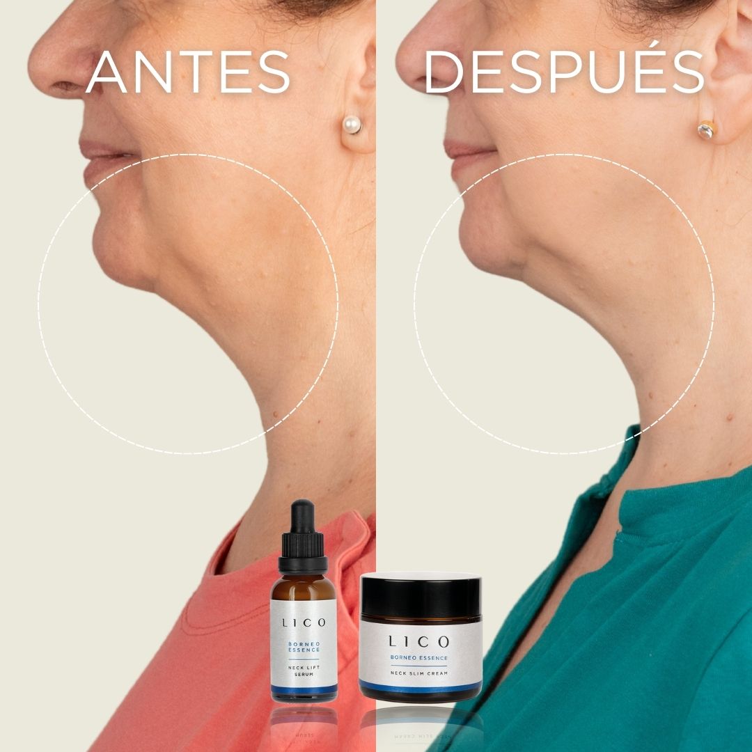 Antes y después Cuello