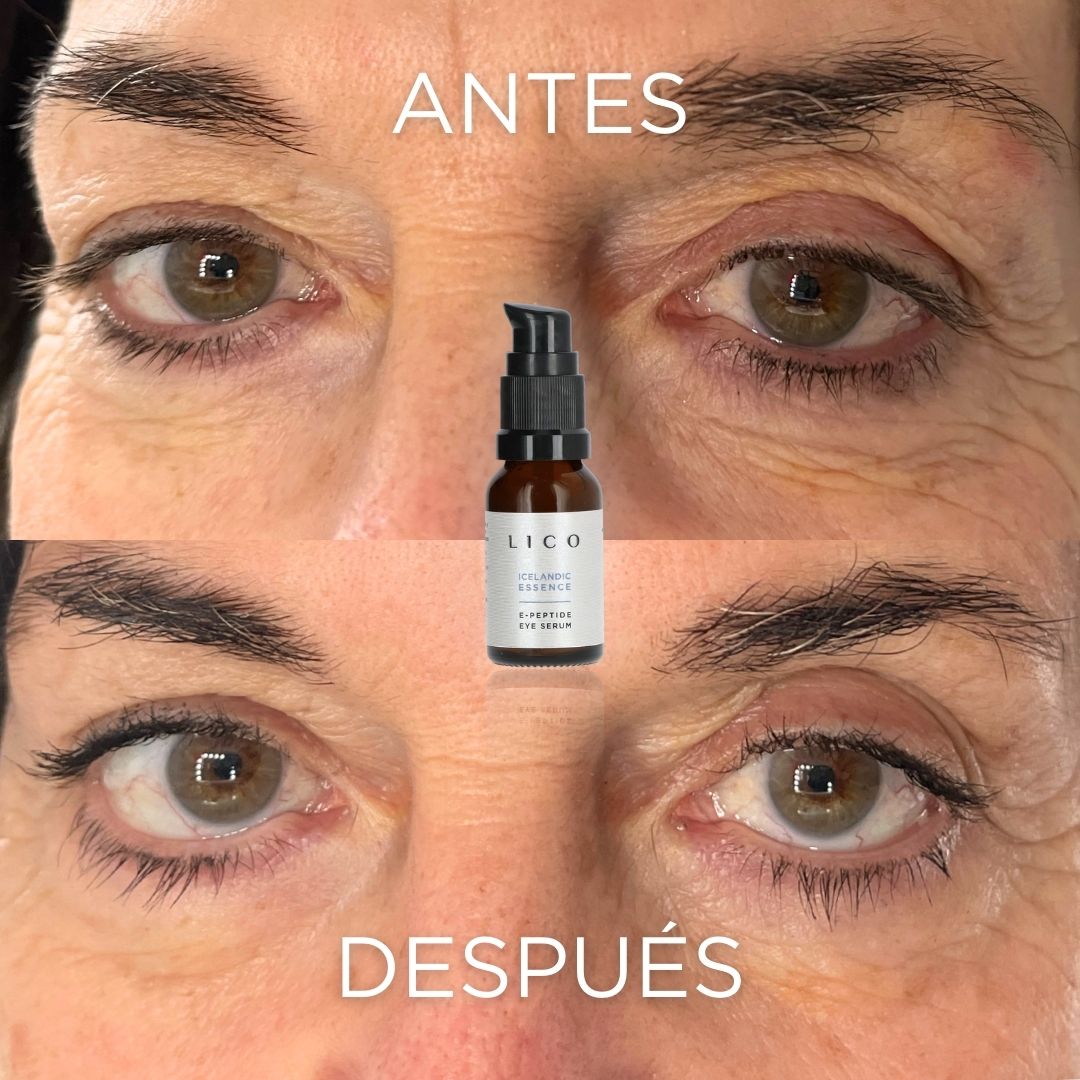Antes y después Contorno de ojos